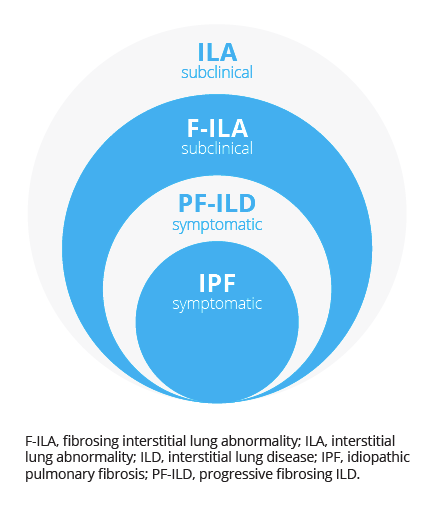 Idiopathic pulmonary fibrosis is the most progressive stage of pulmonary fibrosis.