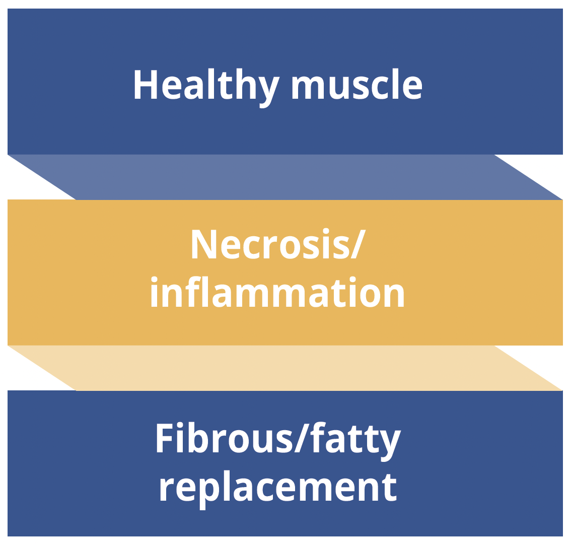 Muscular dystrophies progress from healthy muscle, through a period of necrosis and inflammation which culminates in fibrous